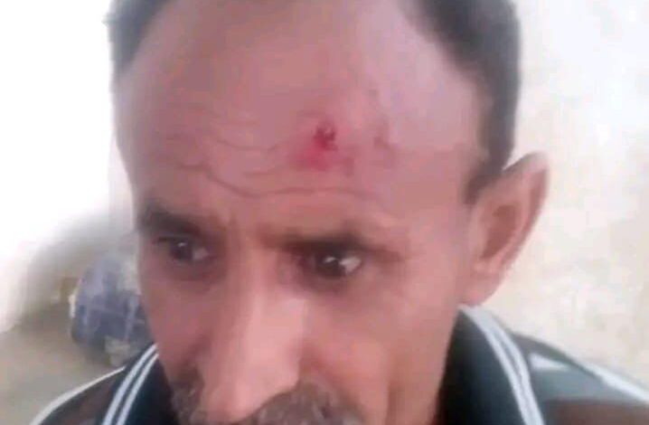 شاهد بالصورة آثار اعتداء أحد القادة الحوثيين على جندي في أمن الجراحي بالحديدة 