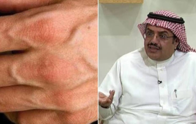 هل شرايين اليد تدل على الإصابة بأمراض القلب؟..طبيب سعودي يكشف مفاجاة