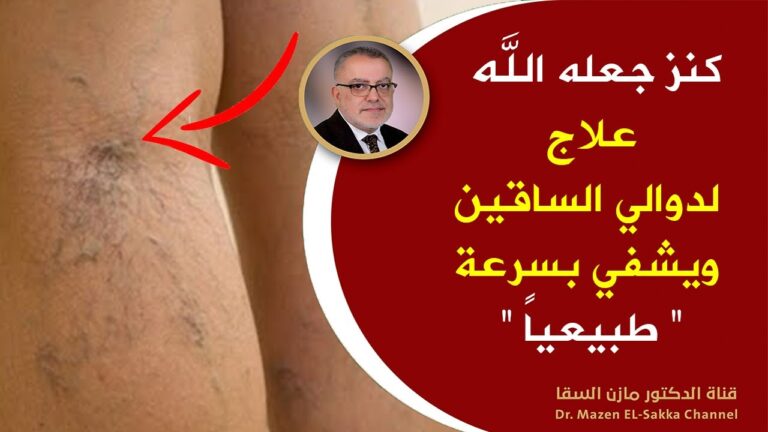 بدون أدوية.. کنز جعله الله علاج لدوالي الساقين ويشفي بسرعة فائقة..« وداعاً للألم »