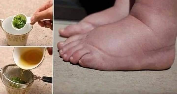 أسهل طريقة للتخلص من احتباس الماء في الجسم الذي يُسبب زيادة الوزن والمظهر السئ للجلد !!