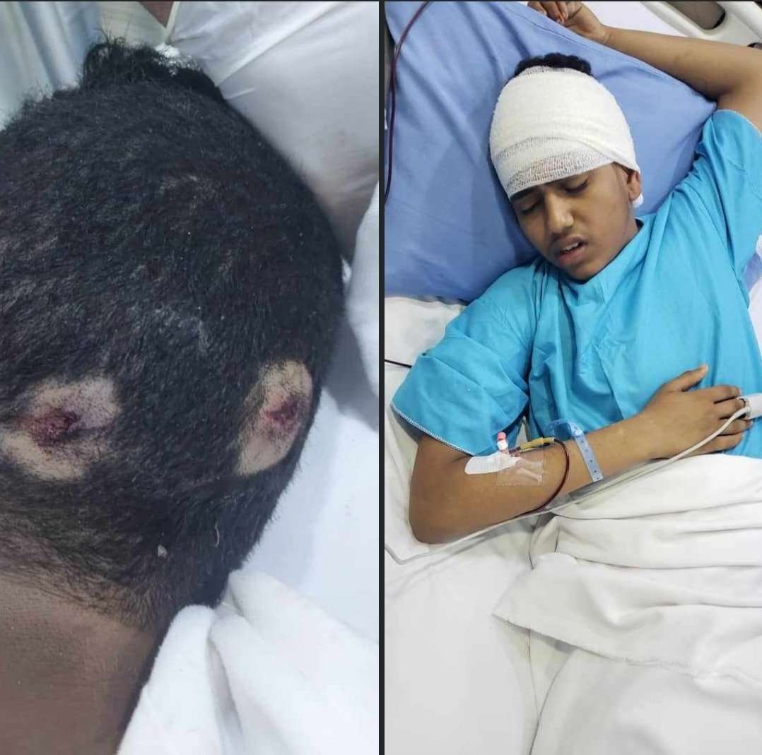 جريمة مروعة تهز الحديدة..طفل يتعرض لتعذيب وحشي حتى أوشك على الموت