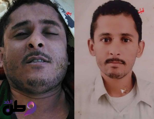 وفاة مختطف في سجون الحوثيين بصنعاء عقب تعرضه للتعذيب