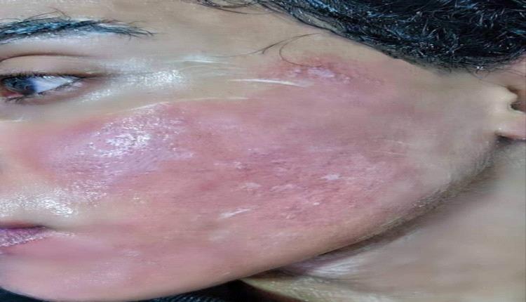إحراق شاب بمادة كيميائية خطيرة بتعز